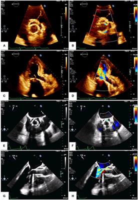 Case report: Paravalvular regurgitation post transcatheter aortic valve replacement: When in doubt choose cardiac magnetic resonance